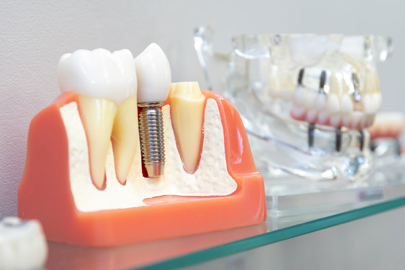 Wondering How You Are Going To Benefit From Dental Implants In The Villages, FL?