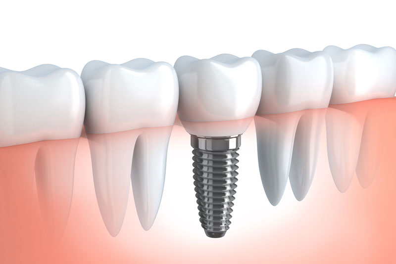 The Four Types Of Dental Implant Restorations