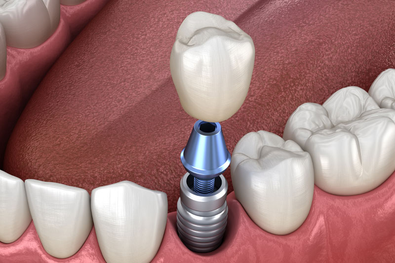 Who Qualifies For Dental Implants?