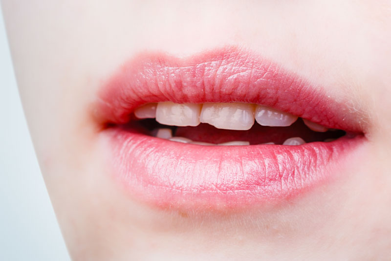 a picture of a woman's open mouth showing teeth that need dental veneers