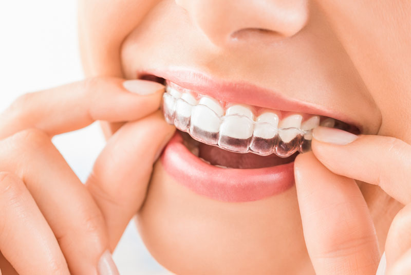 an image of a dental patient happily placing her Invisalign clear aligner on her upper arch of teeth.