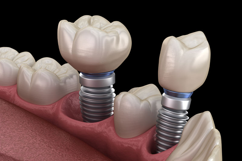 a digital model of a lower jaw showing two o dental implant posts.