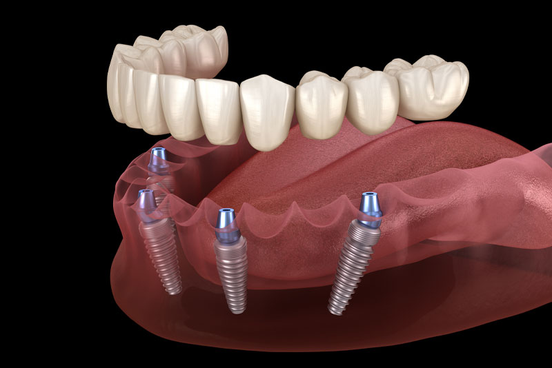 Can My Smile Benefit From Full Mouth Dental Implants In The Villages, FL?