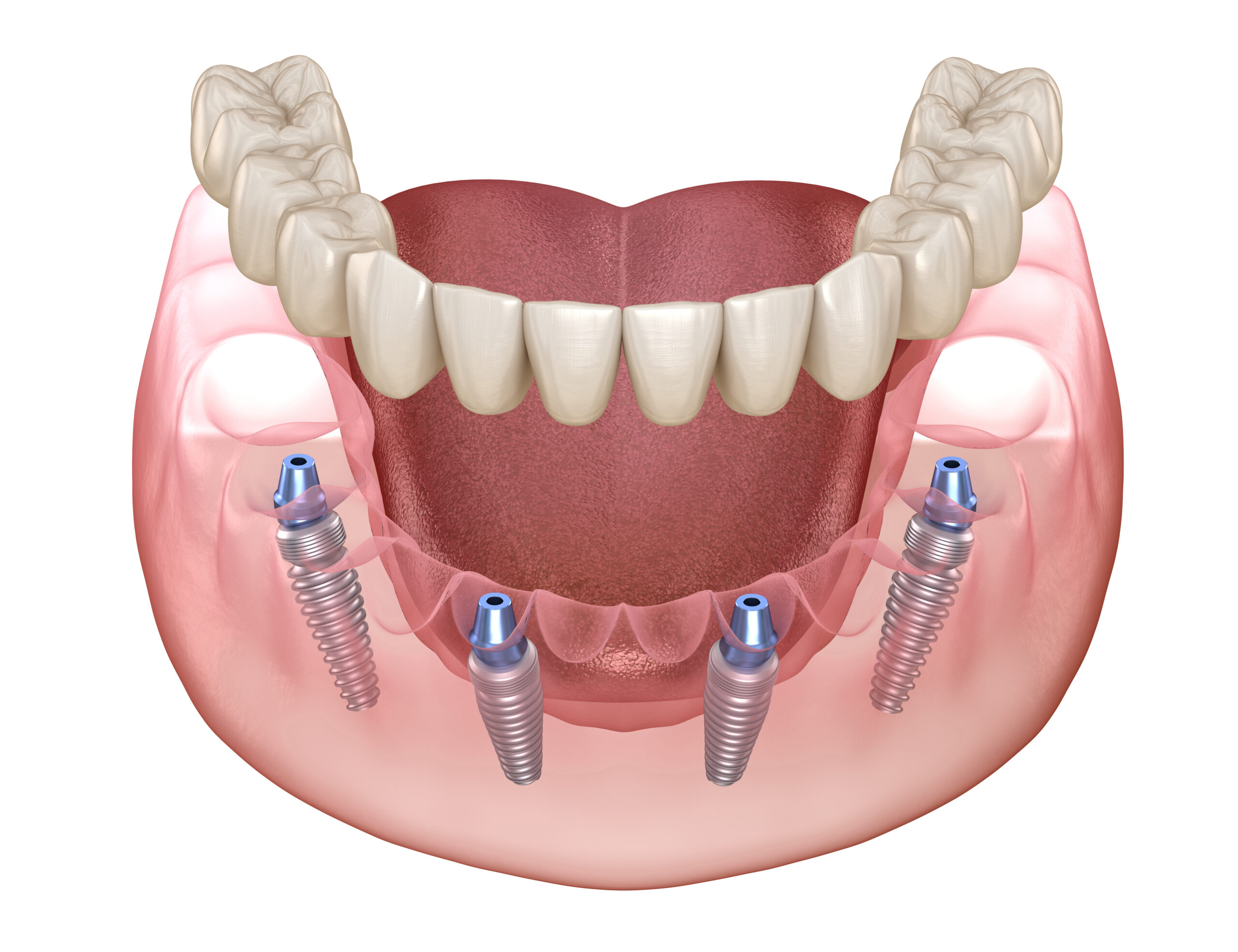Excited For Your Personalized Full Mouth Dental Implants In The Villages, FL? Here Is How They Are Placed