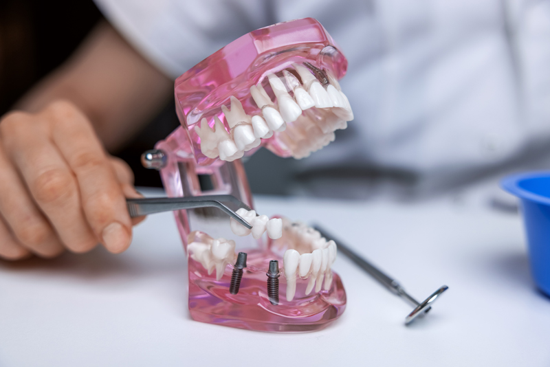 Have Multiple Missing Teeth? You Should Get Treated With Multiple Dental Implants