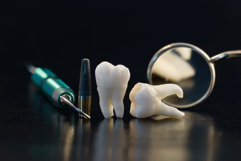 Ready To Learn What A Typical Full Mouth Dental Implant Procedure Looks Like?