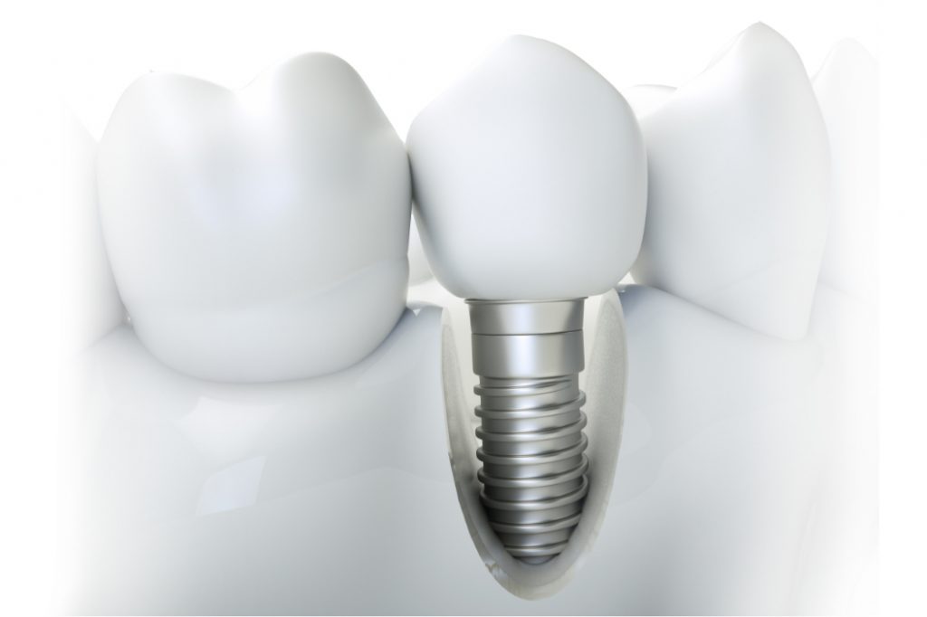 Excited To Find Out What Composes A Dental Implant In The Villages, FL?