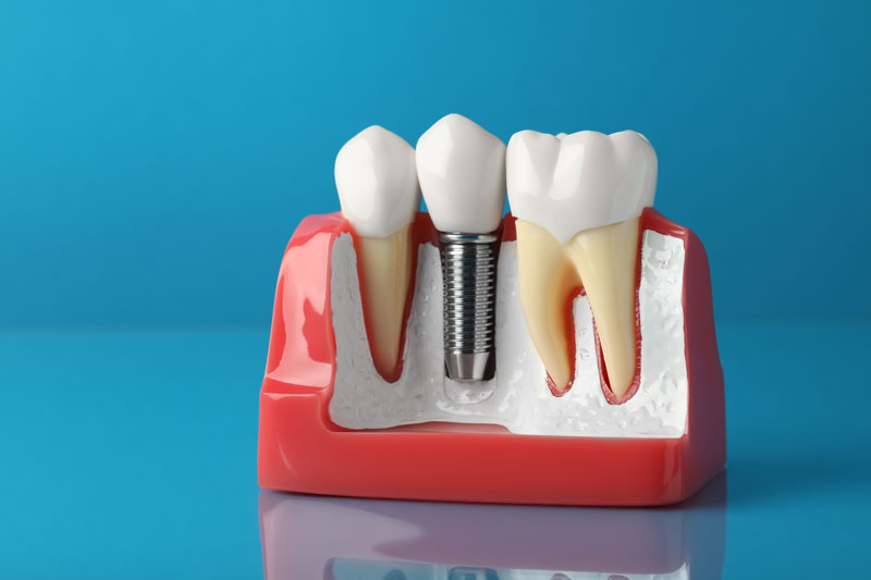 What Complications Can Occur With Dental Implant Placements?